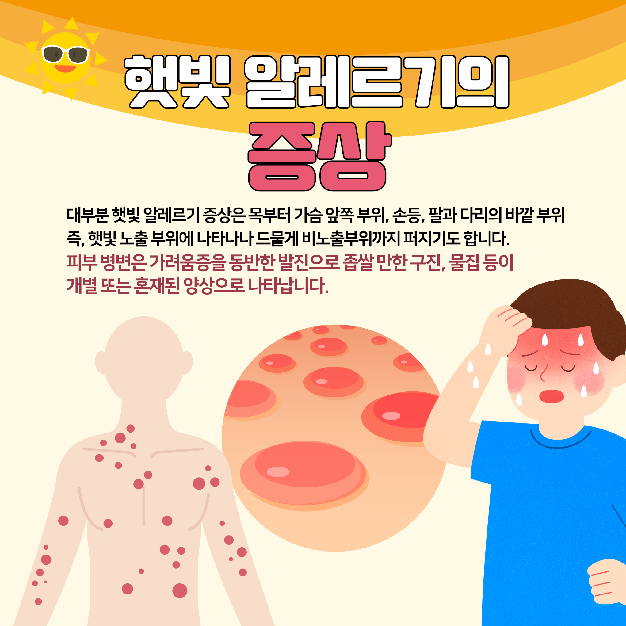 알레르기 피부염