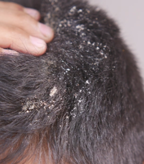 간지럽고 떡 지는 머리&amp;#44; 지루성 두피염 약국 샴푸 니조랄 성분과 효과는?