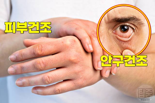 피부당김 얼굴당김 피부건조 가려움 원인 쇼그렌증후군