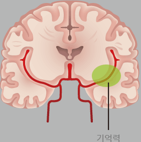 뇌동맥류 증상