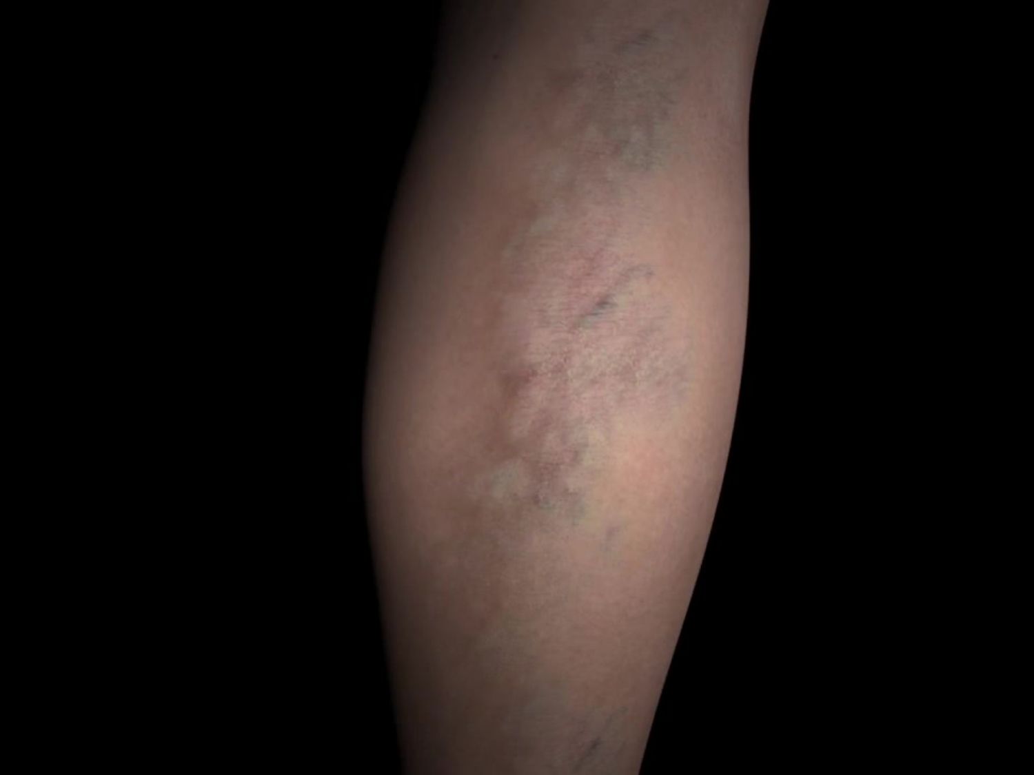 하지정맥류 증상