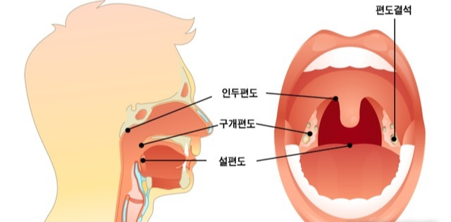 편도의 종륲
