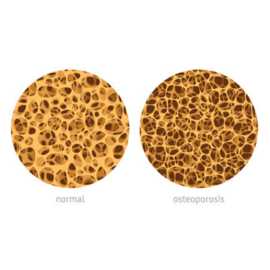 겨울철 골다공증 환자를 위한 골절 예방 가이드