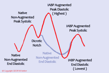 벌룬펌프적용환자의동맥압
