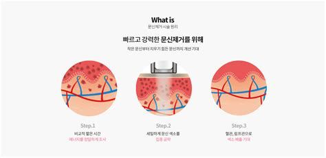 눈비립 종 제거