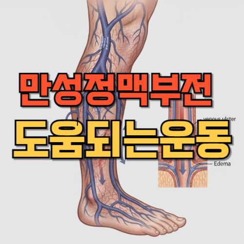 만성정맥부전 운동