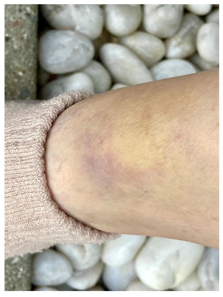 백혈병 초기증상