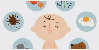 알레르기와 면역