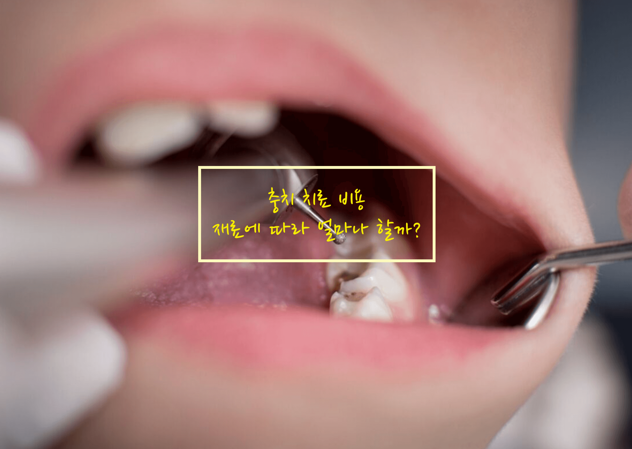 충치 치료 비용