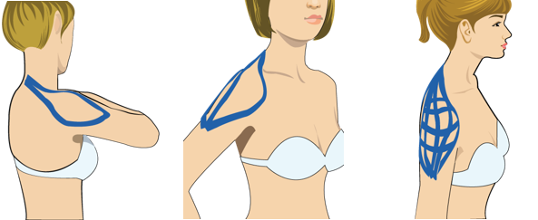 오십견 (유착성 관절낭염)