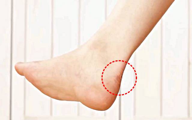 반창고 안떨어지게 붙이는법,발목 밴드 붙이는법