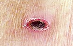 상처부위에 딱딱하게 생기는 가피