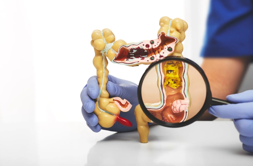 대장암 초기증상 총정리 (증상, 예방, 진단)