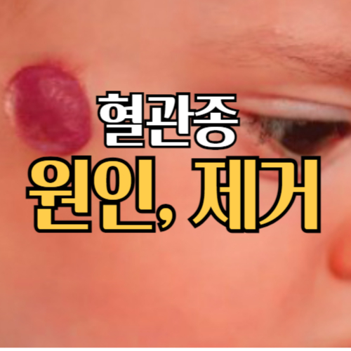 혈관종 증상 원인 치료방법