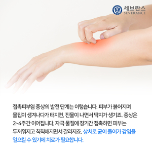 알레르기 피부염