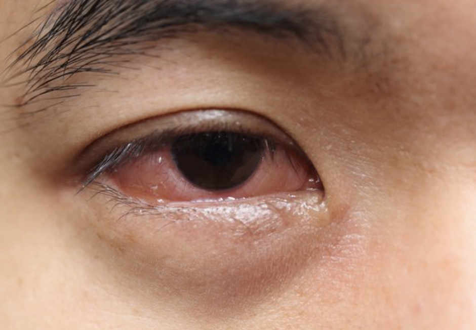 눈에 실핏줄이 터지는 이유