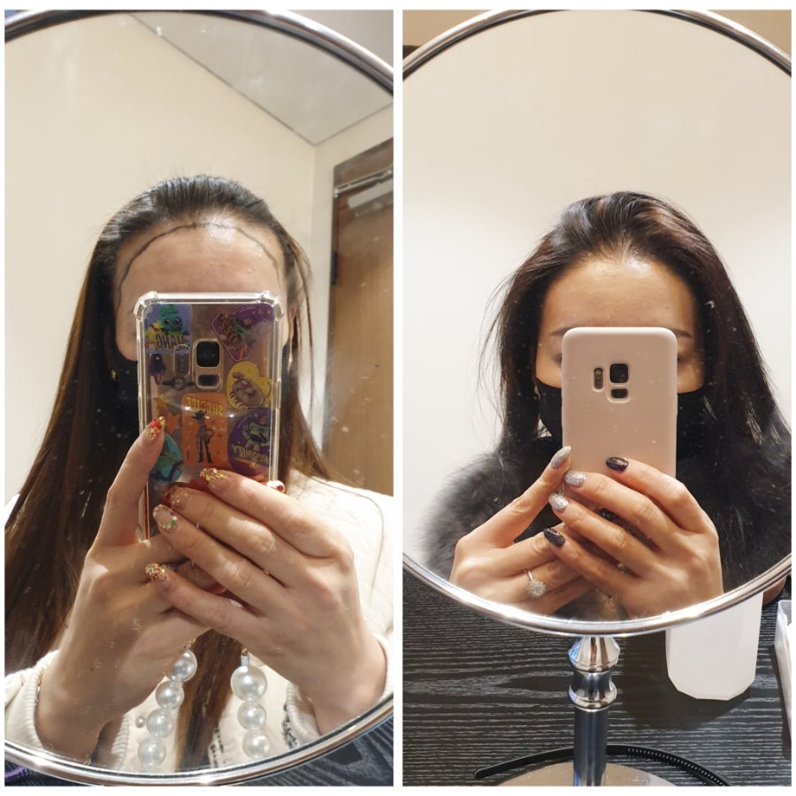 모발이식 사진 전 후