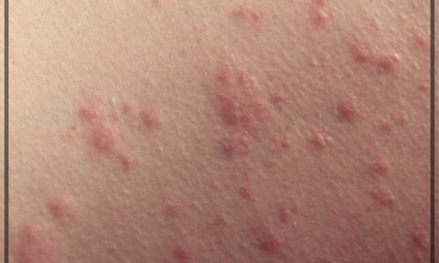 화폐성 피부염 치료방법에 대한 이해