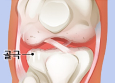 무릎관절염-2기