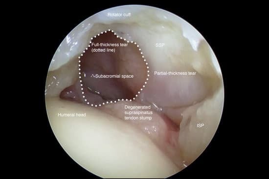 어깨 관절경 수술