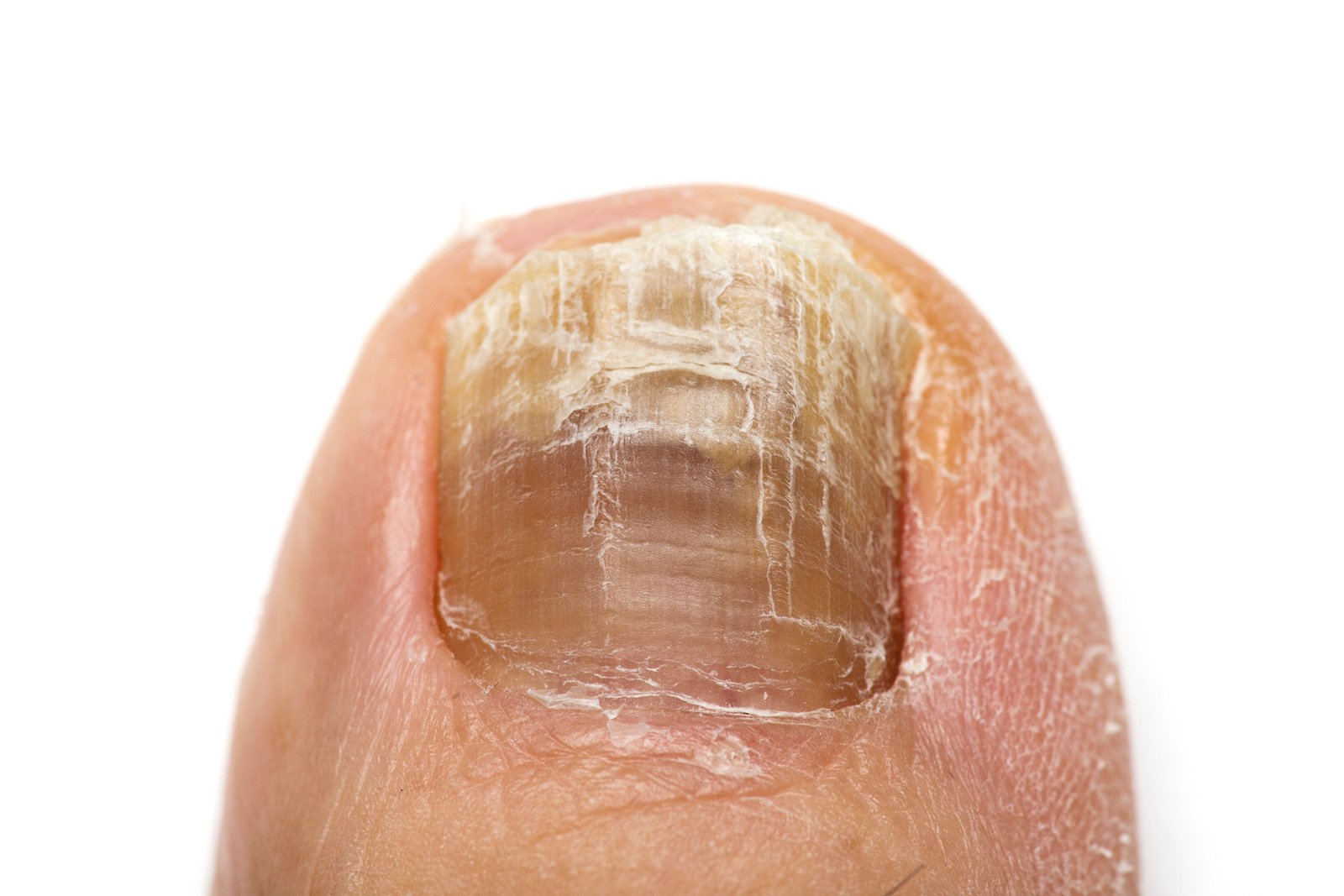 발톱 무좀 (조갑진균증, Onychomycosis) &ndash; 원인, 증상, 치료 방법