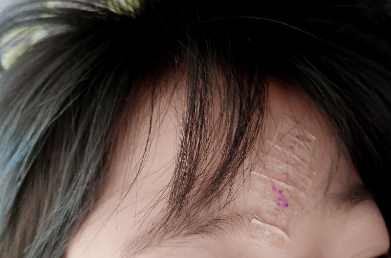 스트리스트립을 꼼꼼하게 붙여준 모습 살색 이라 많이 티나지 않음