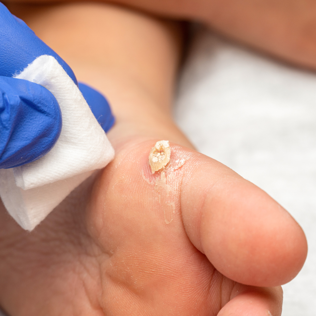 티눈과 굳은살 차이와 치료법, 발바닥 혹 없애는 법