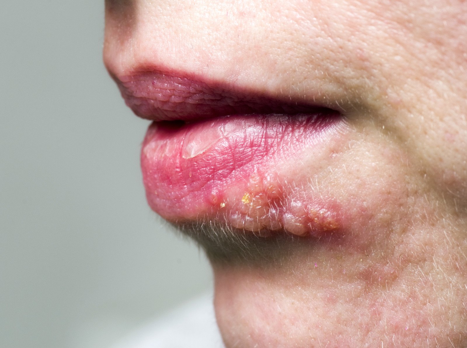 헤르페스 (Herpes Simplex Virus, HSV) – 물집 & 통증 유발 바이러스