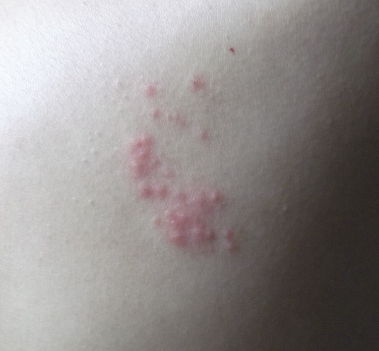 빈대 물린자국 1