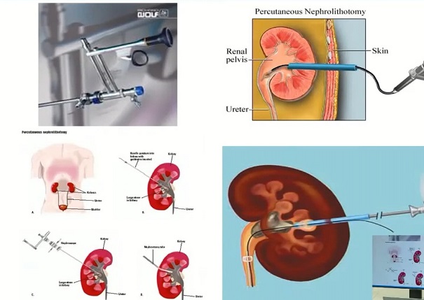 요로결석-구교철-교수