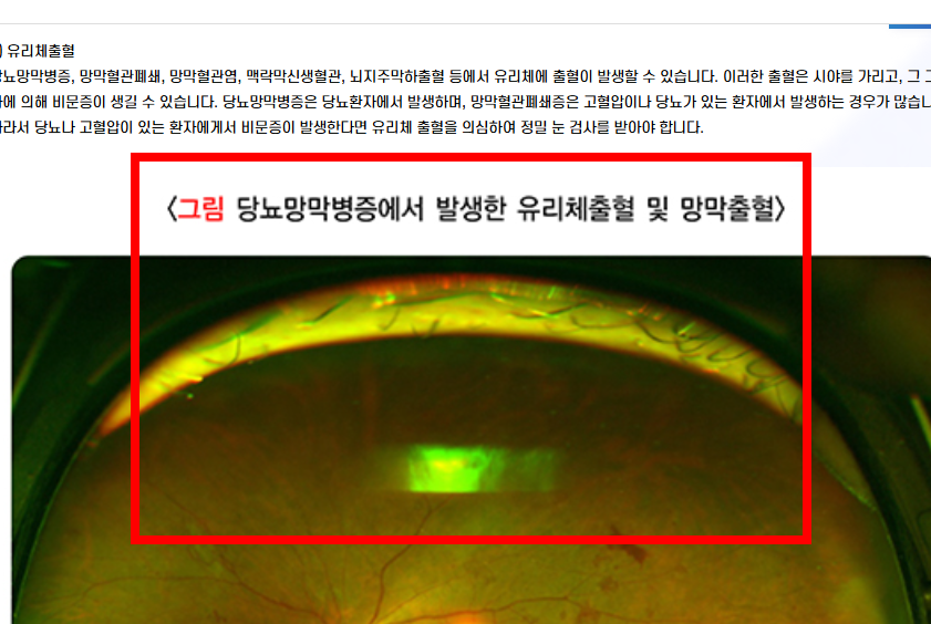 비문증 치료방법 알아보기