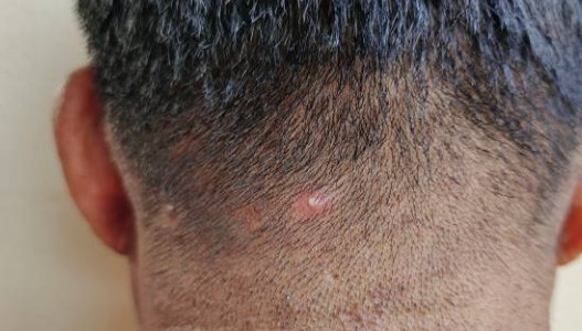 두피 뾰루지
