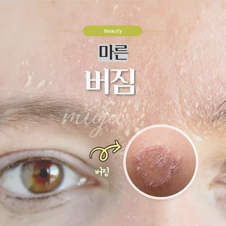 얼굴 버짐 증상 없애는 실전 방법 5가지 및 관리요령_7