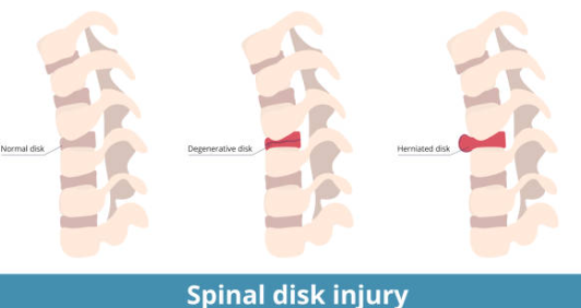 허리 디스크 단계