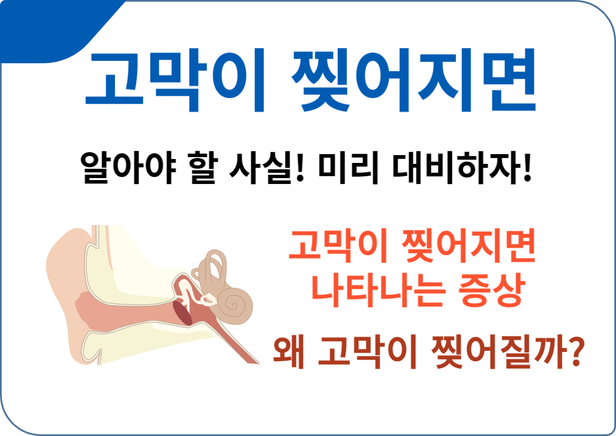 고막이 찢어지면 알아야 할 사실! 미리 대비하자! 고막은 우리가 세상의 소리를 듣는 데 핵심적인 역할을 하는 작은 부분입니다. 하지만 이 중요한 부위가 손상을 입을 경우&#44; 우리의 생활에 큰 영향을 미칠 수 있습니다. 오늘은 고막이 찢어질 때 나타나는 증상&#44; 그 원인&#44; 그리고 이를 예방하는 방법에 대해 알아보도록 하겠습니다.