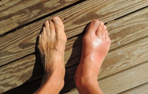 통풍 초기증상과 원인, 요산수치 낮추는법