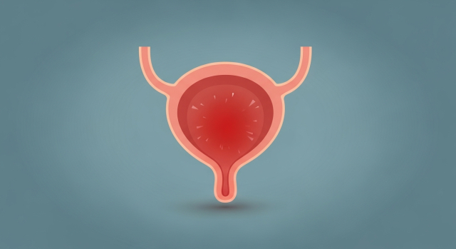 방광 안쪽 점막에 생긴 작은 종양 덩어리를 표현한 방광암 일러스트