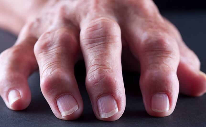 손가락퇴행성관절염진단