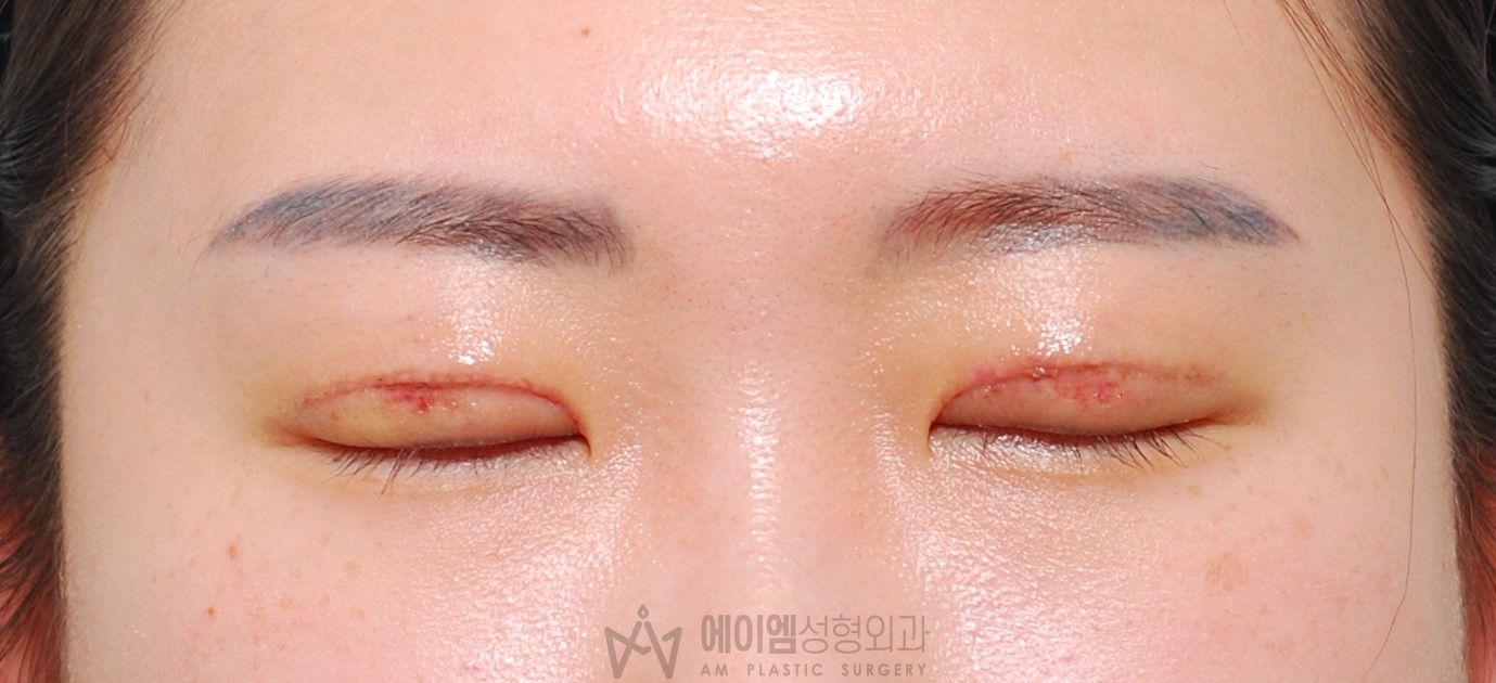 소세지눈 두줄따기 10일 눈감은사진
