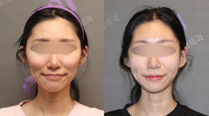 옆광대축소주사