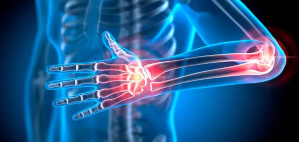 류마티즘 관절염 관련 사진