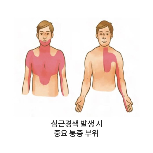 협심증 주요 증상