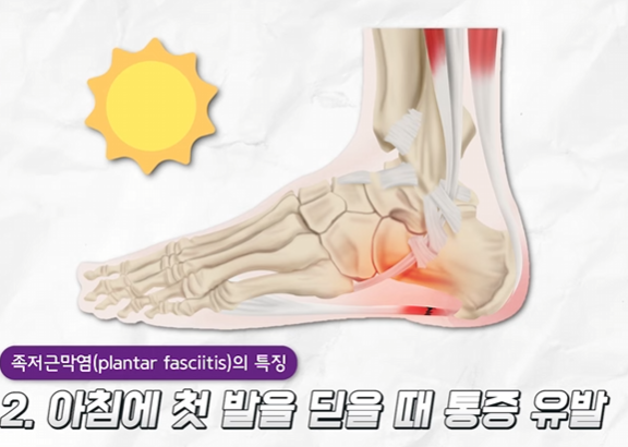 족저근막염2
