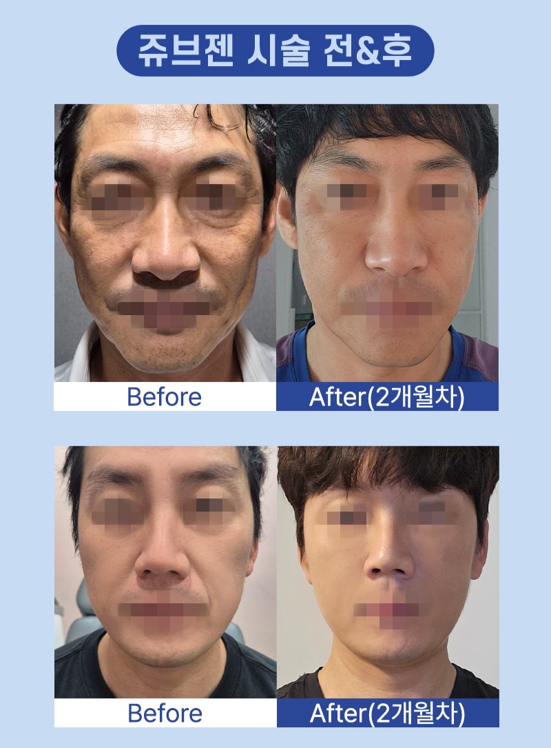 삼성역 팔자주름 피부과 (2).jpg