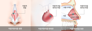 비중격 만곡증
