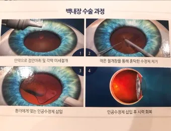 백내장 수술 비용 실비 보험 청구 회복기간_10