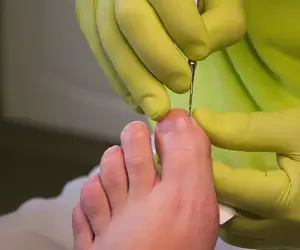 발톱무좀