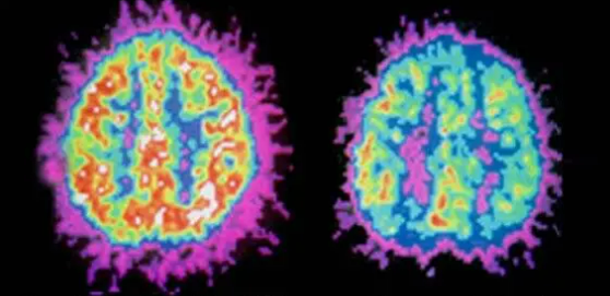 성인 ADHD 콘서타 약 먹고 부작용으로 속 울렁거려서 힘들었네요