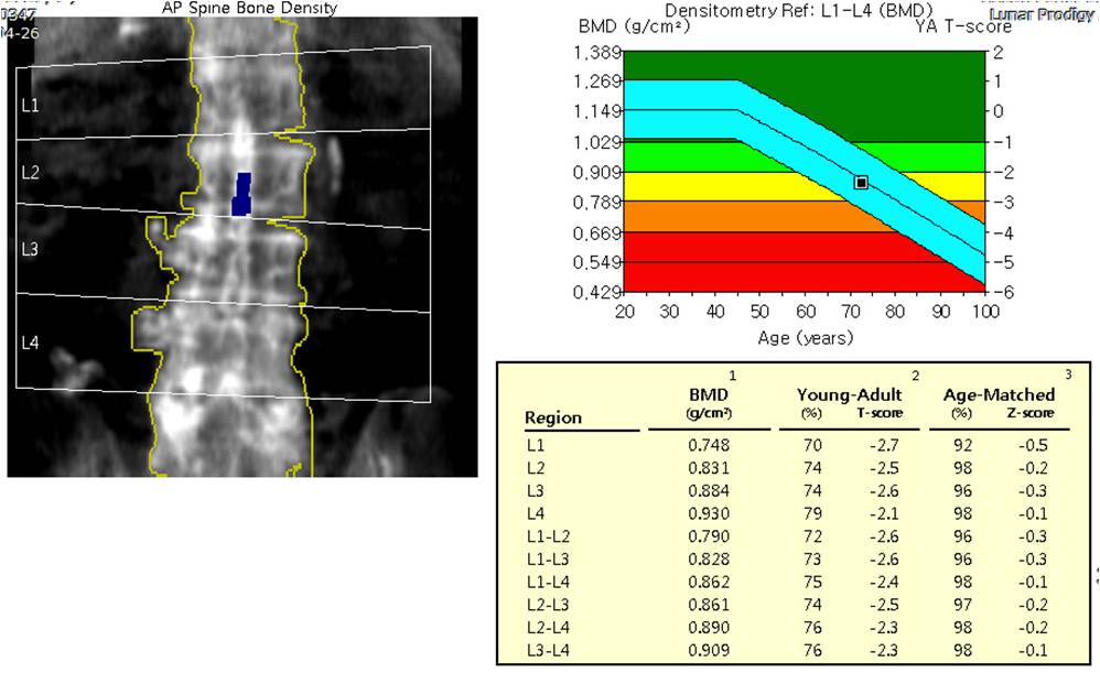 골밀도 검사 사진출처 대학정형외과 학회 홈페이지