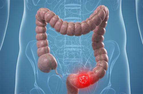 대장에 좋은 음식과 안 좋은 음식